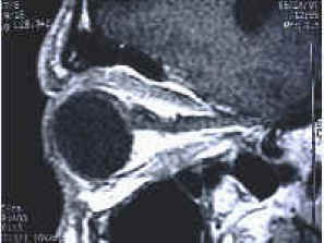 Sagittal view of the orbit