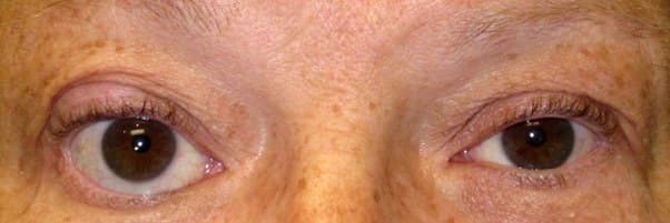 Before Graves Disease / Eyelid Recession — case Lower-lid recession with TarSys spacer graft